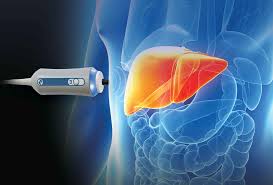 Fibroscan