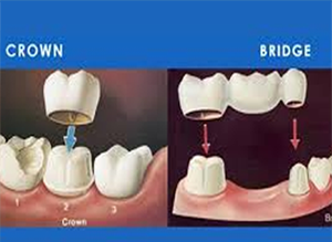 Dental Crowns & Bridges