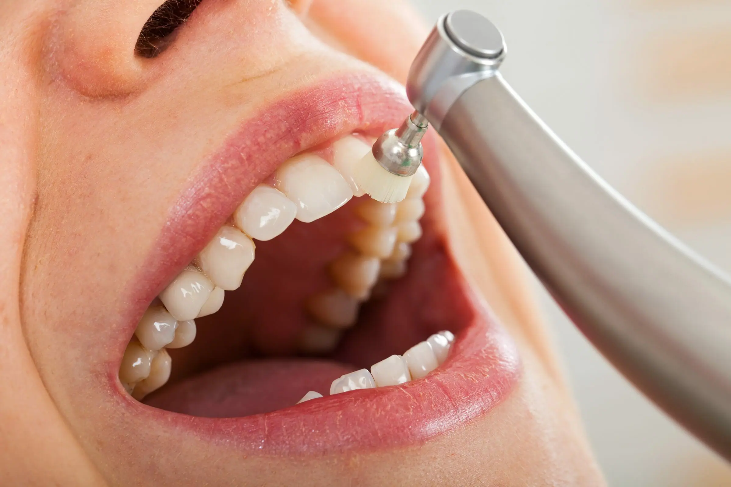 Dental Scaling