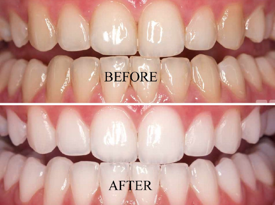 Teeth Whitening